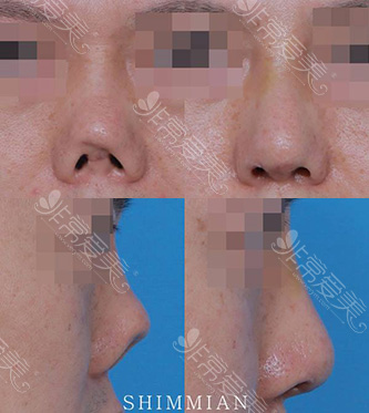 韩国心美眼整形外科鼻修复图