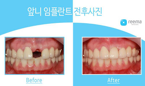 韩国Reema利玛牙科牙齿种植日记