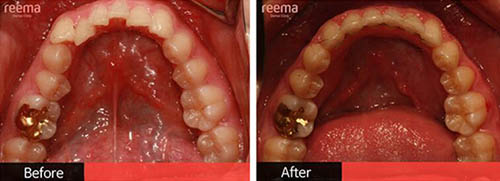 韩国Reema利玛牙科官网牙齿矫正案例