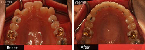 韩国Reema利玛牙科牙齿矫正前后对比