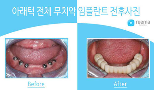 韩国Reema利玛牙科牙齿种植日记图