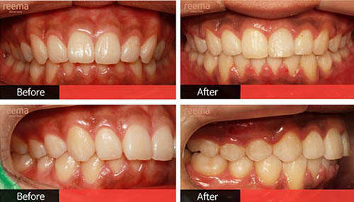 韩国Reema利玛牙科咬合不齐牙齿整形案例
