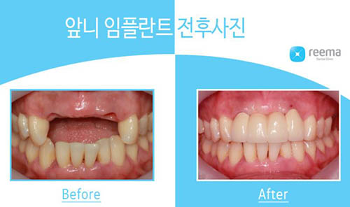 韩国Reema利玛牙科门牙种植案例图