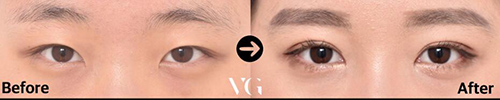 韩国VG百利酷整形外科眼部整形案例