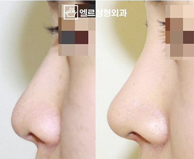 硅胶隆鼻手术对比案例