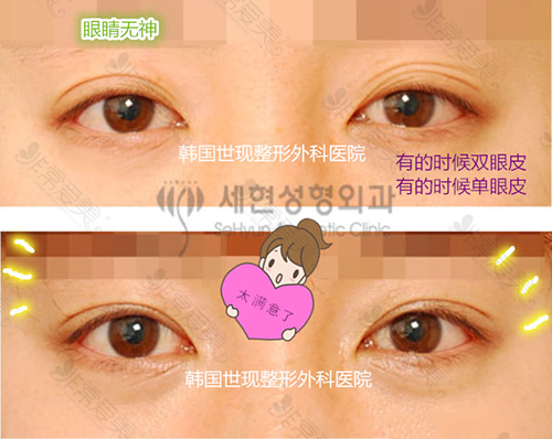 韩国世现整形医院双眼皮手术