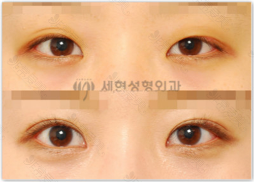 韩国世现整形医院双眼皮手术前后对比图