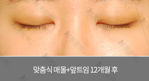 韩国世现整形医院双眼皮手术疤痕图
