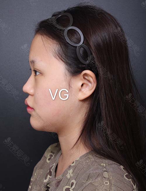 韩国VG百利酷隆鼻面吸术前侧面
