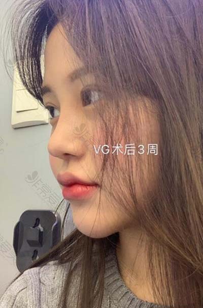 韩国VG百利酷隆鼻面吸恢复期照片