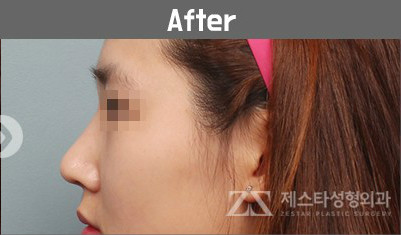 韩国zestar整形外科鼻部手术案例