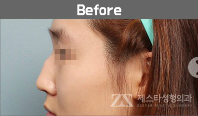韩国zestar整形外科驼峰鼻矫正