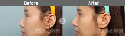 韩国zestar隆鼻手术案例