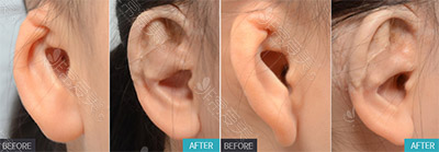 韩国普罗菲耳医院小耳畸形治疗恢复过程
