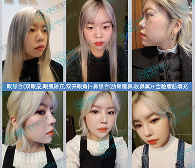 韩国NANA娜娜整形外科眼鼻轮廓整形前后对比照片