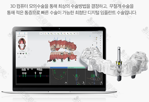 韩国安特丽牙科通过电脑模拟确定种植牙方案示意图