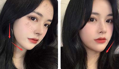 韩国VG百利酷官网日记公布，真人眼鼻轮廓修复3个月效果！