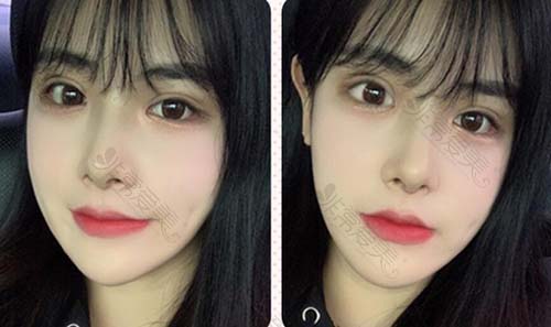 韩国VG百利酷官网案例公布，真人眼鼻轮廓修复3个月效果！