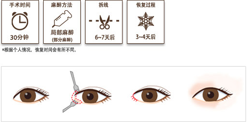 韩国初雪眼部手术特点图解