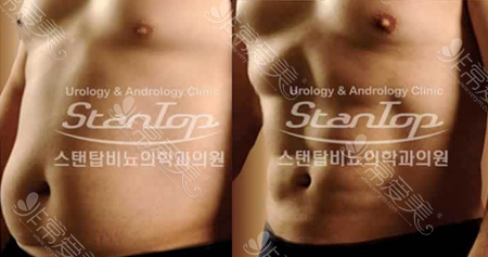 韩国世檀塔男科医院男性腰腹吸脂前后对比