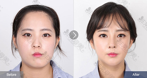 韩国凸嘴手术多少钱?凸嘴手术哪里做好?前后对比照片曝光！