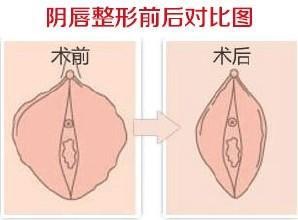 外阴肥大有什么危害？韩国擅长阴唇整形的医院有哪些？