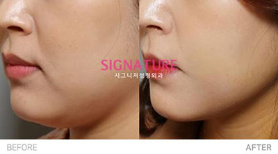 韩国Signature整形外科轮廓整形照片