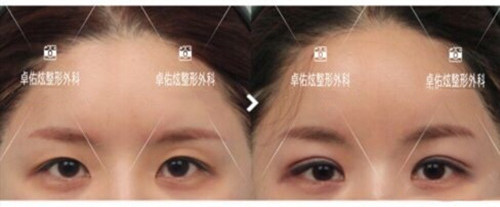 韩国卓佑炫整形外科改善眼皮厚重案例