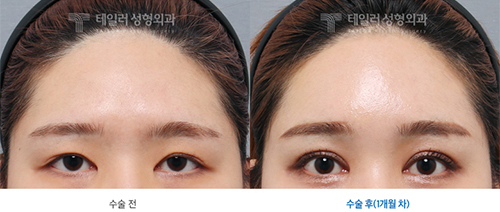 韩国卓佑炫双眼皮修复案例对比