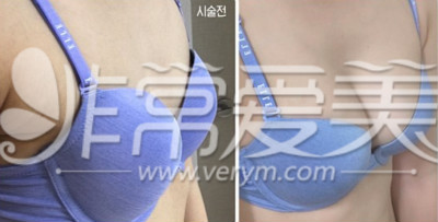 韩国star自体脂肪隆胸真人案例对比