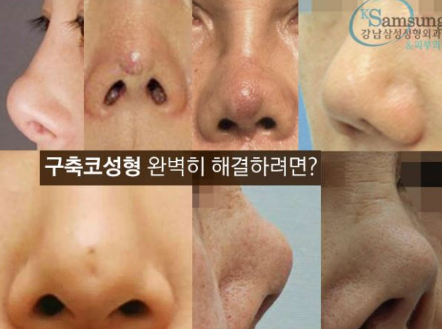 去韩国鼻修复需要多少钱