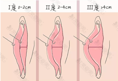 蝴蝶阴很丑要怎么改善？