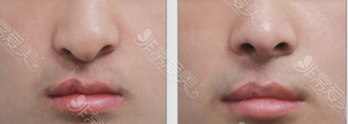 韩国MVP整形外科唇腭裂手术前后对比