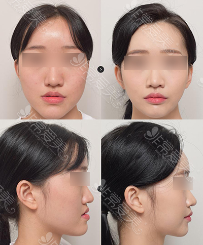 韩国EU颌面轮廓整形外科双鄂手术图