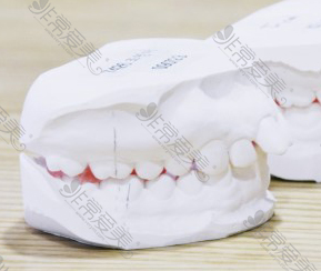嘴突整形多少钱？无法通过牙箍矫正的原因在哪？