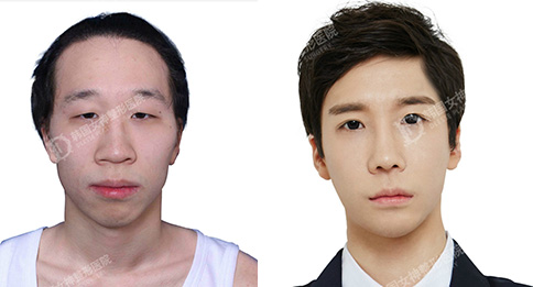 韩国女神医院男性面部轮廓案例