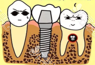 种植牙的术后护理图