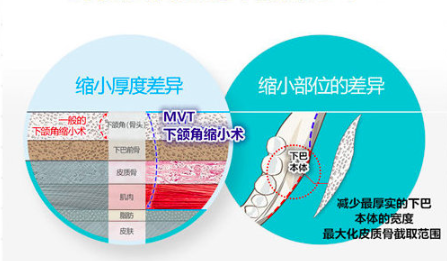 韩国ID整形外科下颌角切除范围示意图