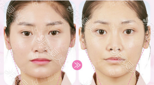 韩国ID整形外科下颌角图