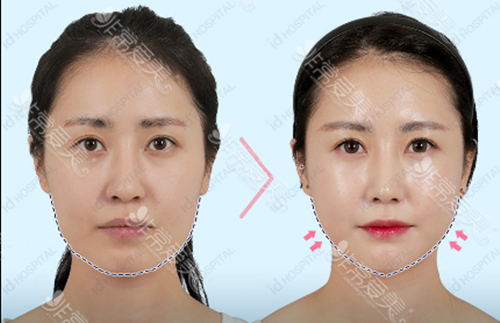 韩国ID整形外科下颌角手术