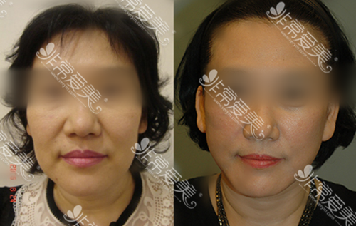 韩国bio整形拉皮手术对比图