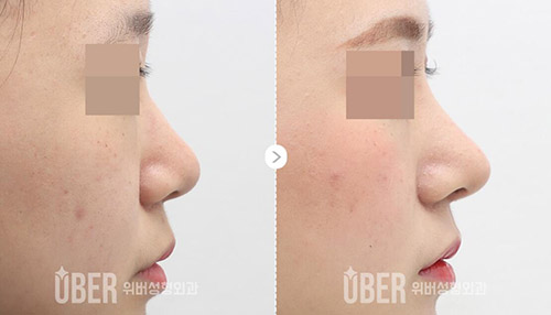 韩国玉芭整形外科隆鼻前后对比
