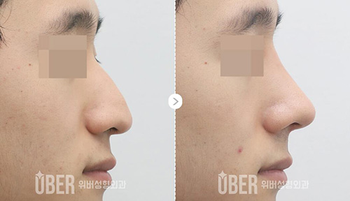 韩国玉芭uber整形外科鹰钩鼻矫正前后对比