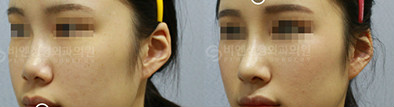 韩国BN隆鼻手术自拍案例