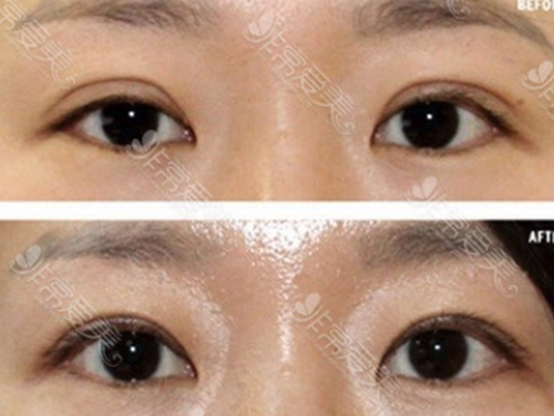 韩国初雪整形外科双眼皮修复