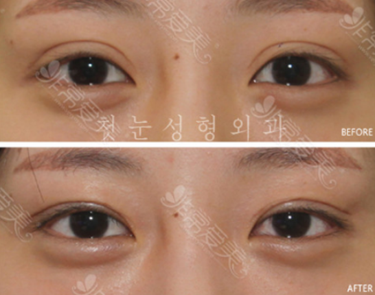 双眼皮修复困难吗?韩国整形医院双眼皮修复效果怎么样？