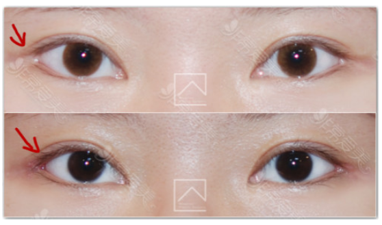 韩国Misoline整形外科外眼角修复