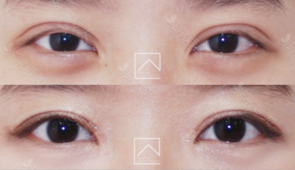 韩国Misoline整形外科双眼皮不对称修复