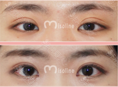 韩国Misoline整形外科肉条眼修复图