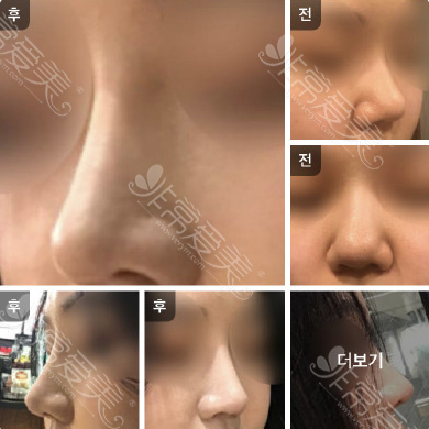 韩国cocoline整形医院女性翘鼻整形